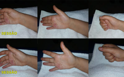 Tratamento de fisioterapia pós-cirúrgico “Dedo em gatilho”